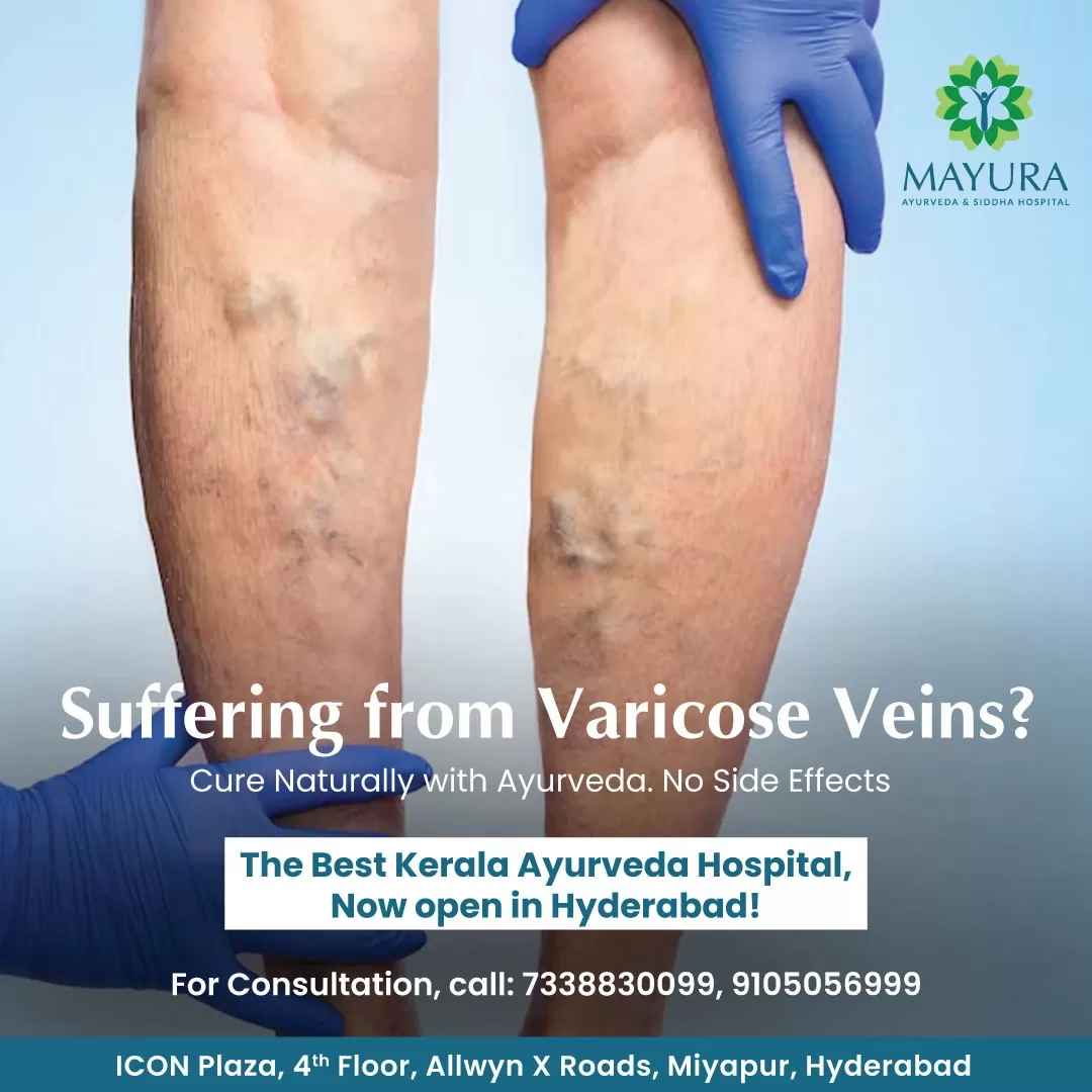 Ayurvedic treatment for suffering from varicose veins problems.