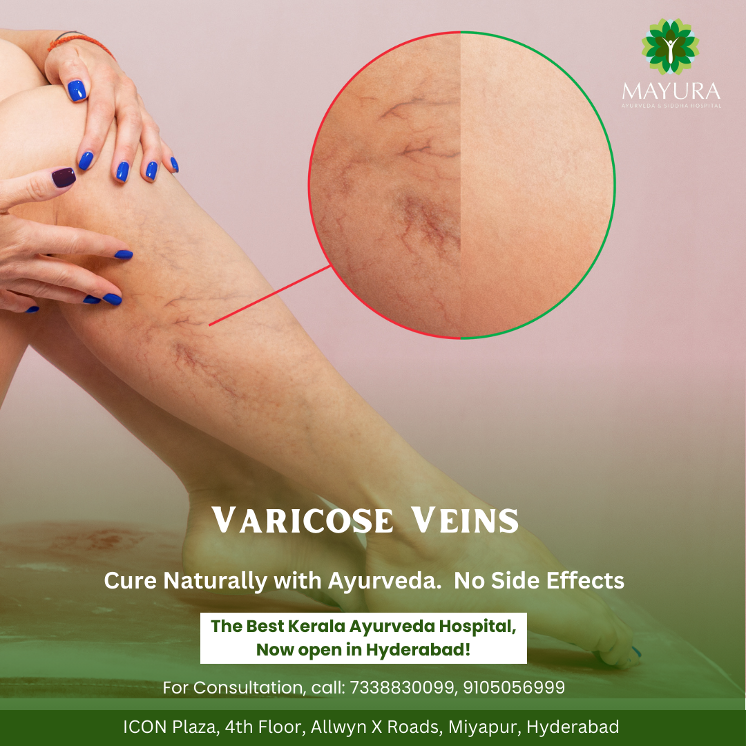 Ayurvedic treatment for varicose veins