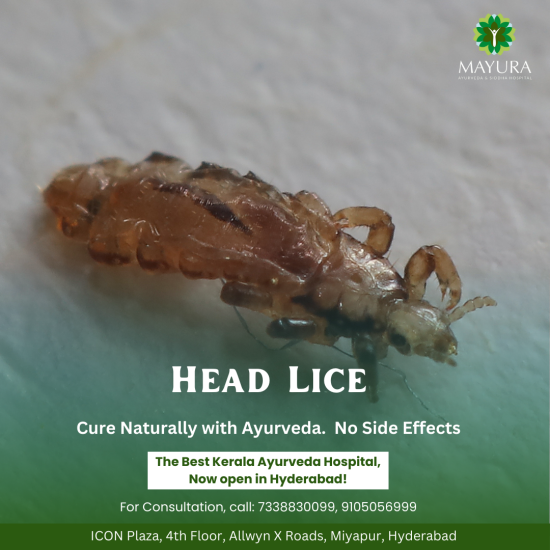 Effective Head Lice Treatment at Mayura Ayurveda and Siddha Hospital